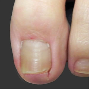 nail fungus post