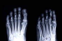 Understanding Fused Joints in the Feet